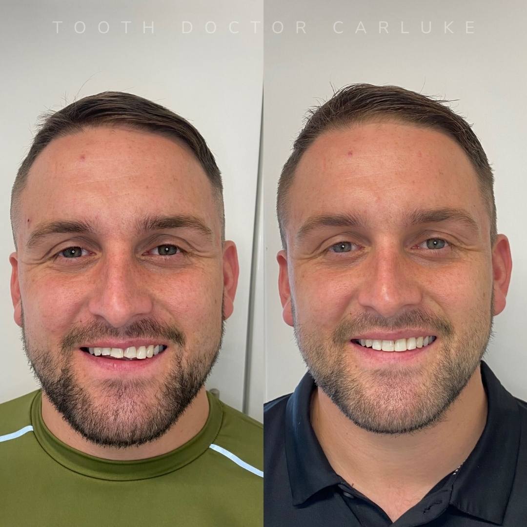 Tooth Doctor | Tooth Doctor Carluke Before and after treatment
