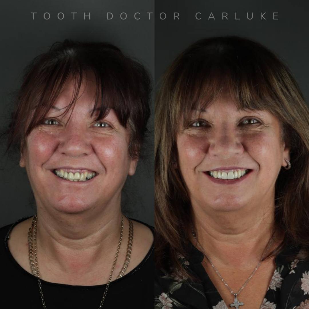 Tooth Doctor | Tooth Doctor Carluke Before and after treatment