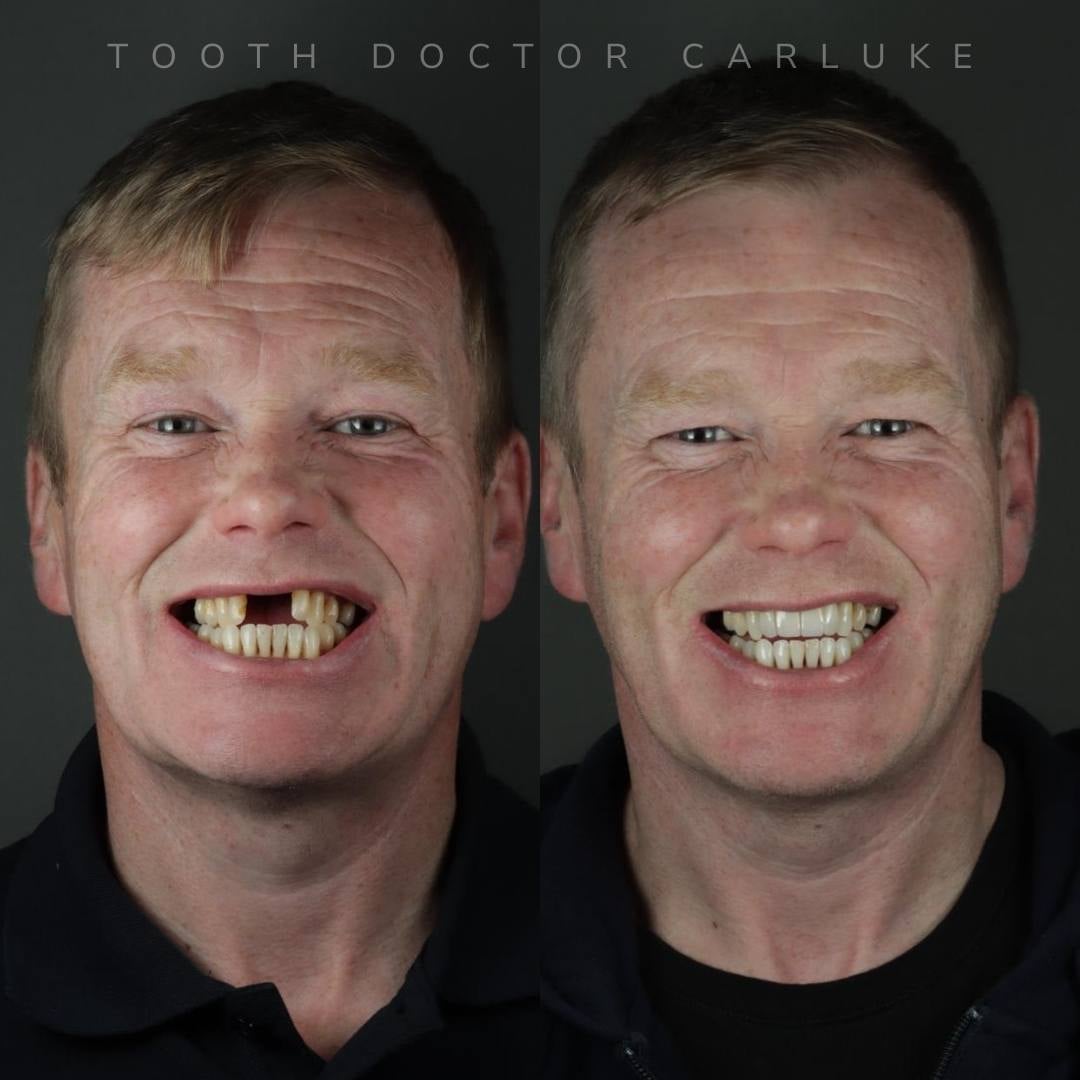 Tooth Doctor | Tooth Doctor Carluke Before and after treatment